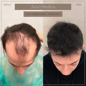Trasplante de cabello antes y después 2023 1