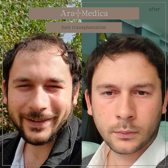 Trasplante de cabello antes y después 2023 25
