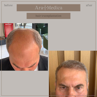 Trasplante de cabello antes y después 2023 27