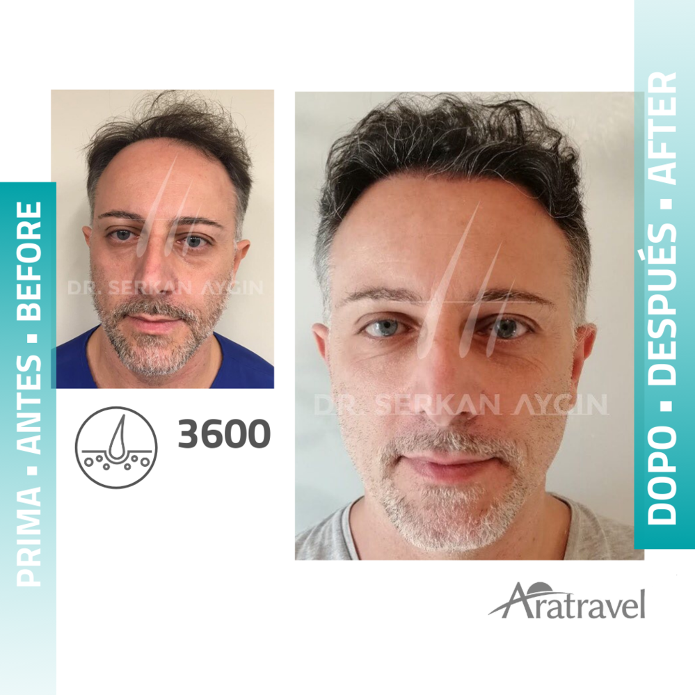 El resultado de los trasplantes de cabello en un paciente antes y después