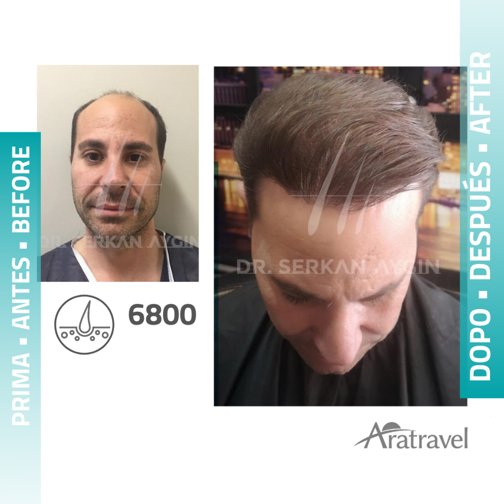 Trasplante de cabello antes y después 2021 04