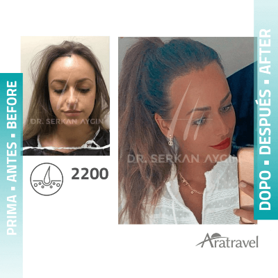 Fotos de una mujer antes y después del trasplante de cabello con técnica FUE - 1