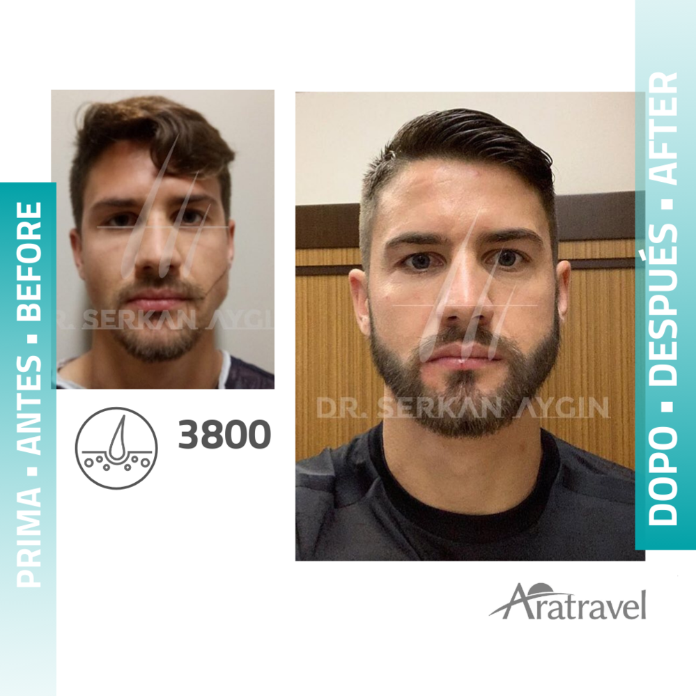 Trasplante de cabello antes y después 2021 06