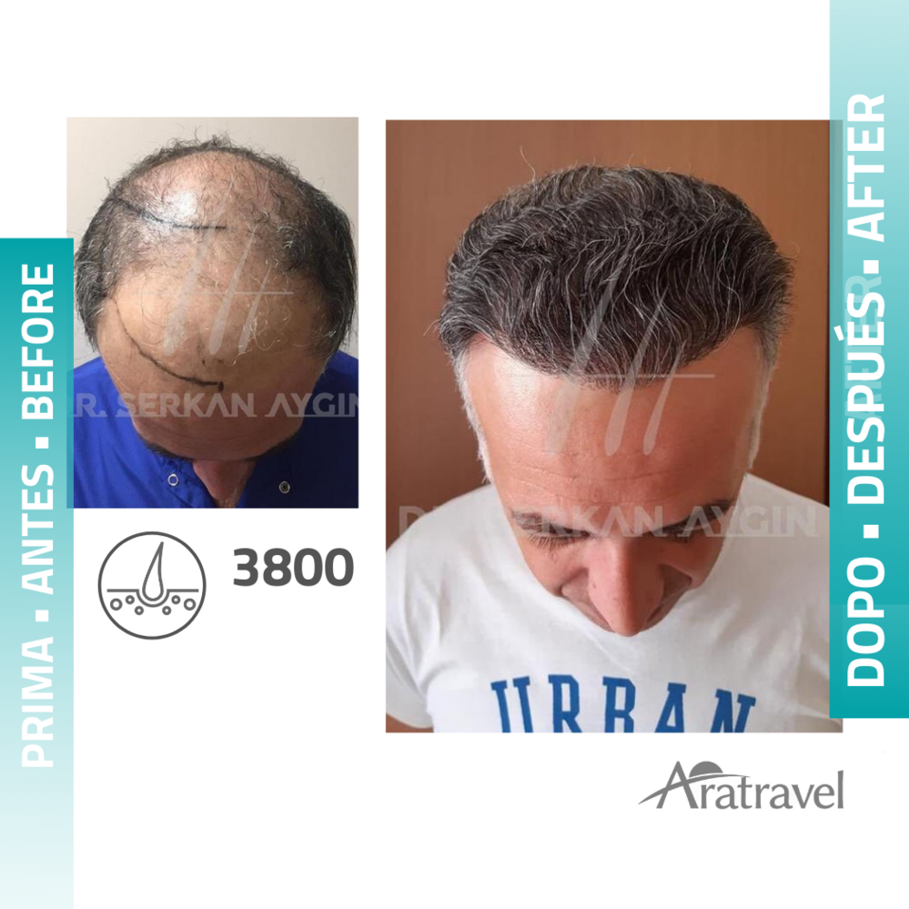El resultado natural de los trasplantes de pelo con técnica FUE - antes y después de la cirugía