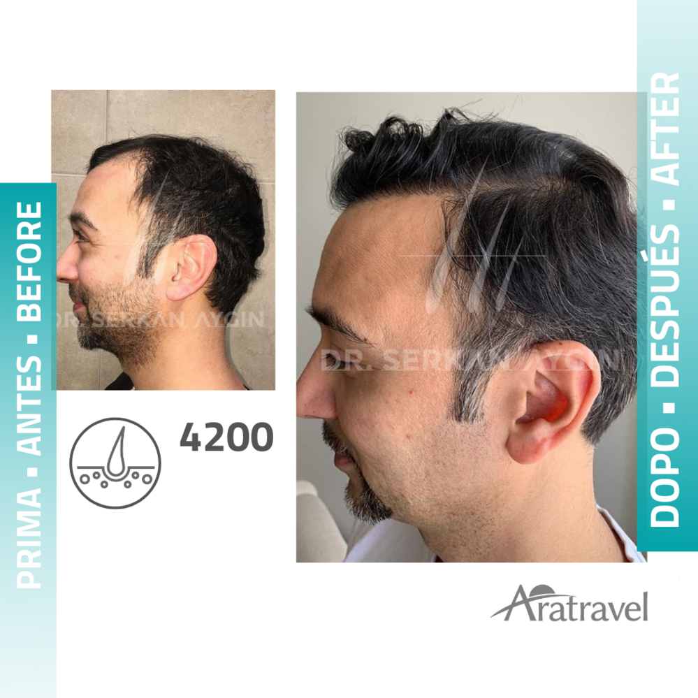 Trasplante de cabello antes y después 2021 15