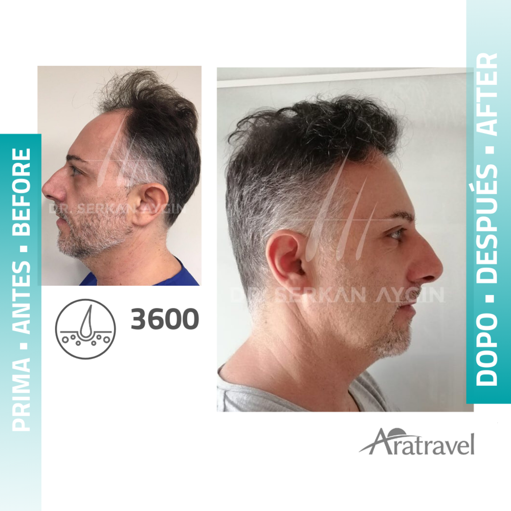 Trasplante de cabello antes y después 2021 18