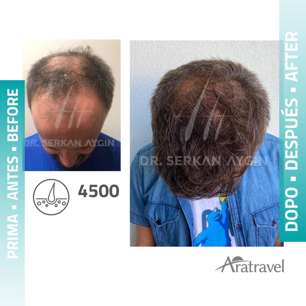 Trasplante de cabello antes y después 2021 19