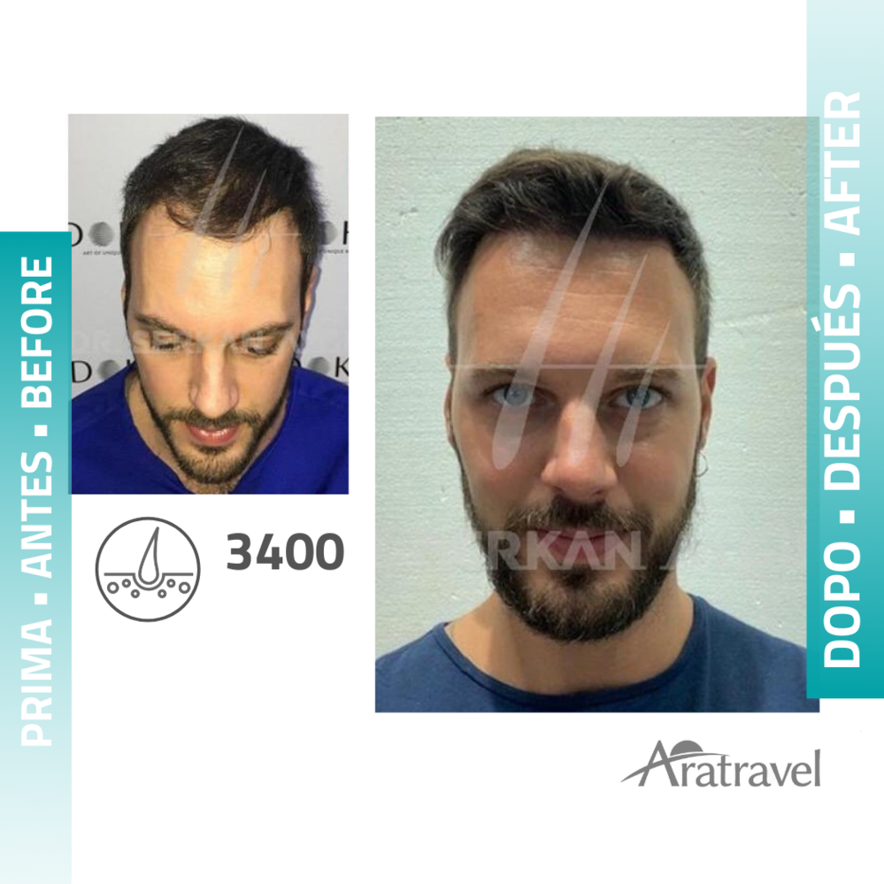 Trasplante de cabello antes y después 2021 21