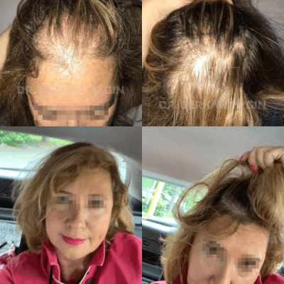 Fotos de una mujer antes y después del trasplante de cabello con técnica FUE - 3