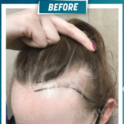 Fotos de una mujer antes y después del trasplante de cabello con técnica FUE - 8