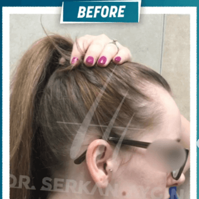 Fotos de una mujer antes y después del trasplante de cabello con técnica FUE - 9