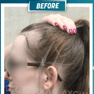 Fotos de una mujer antes y después del trasplante de cabello con técnica FUE - 10