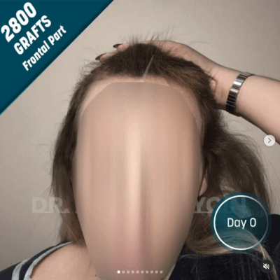 Fotos de una mujer antes y después del trasplante de cabello con técnica FUE - 14