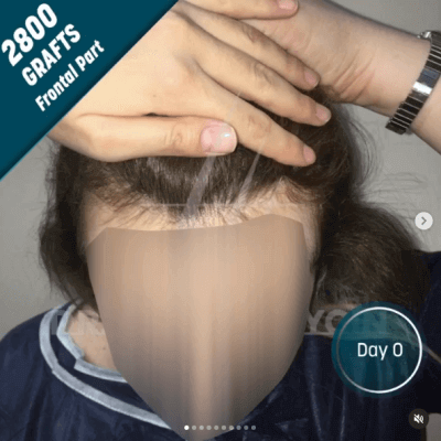 Fotos de una mujer antes y después del trasplante de cabello con técnica FUE - 15