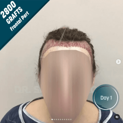 Fotos de una mujer antes y después del trasplante de cabello con técnica FUE - 17