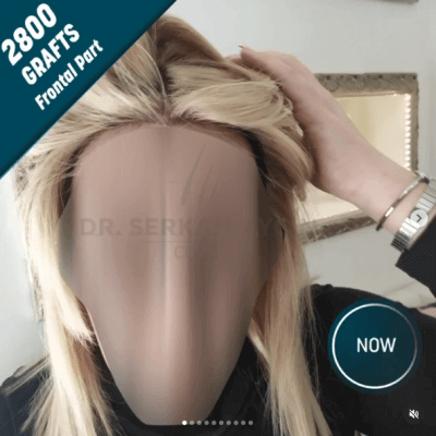 Fotos de una mujer antes y después del trasplante de cabello con técnica FUE - 21