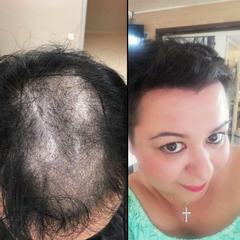 Fotos de una mujer antes y después del trasplante de cabello con técnica FUE - 4