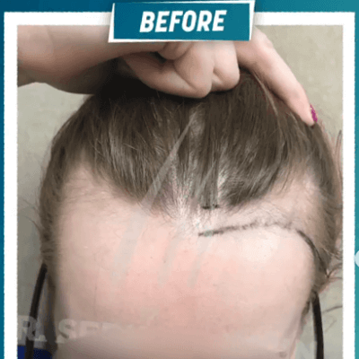 Fotos de una mujer antes y después del trasplante de cabello con técnica FUE - 7