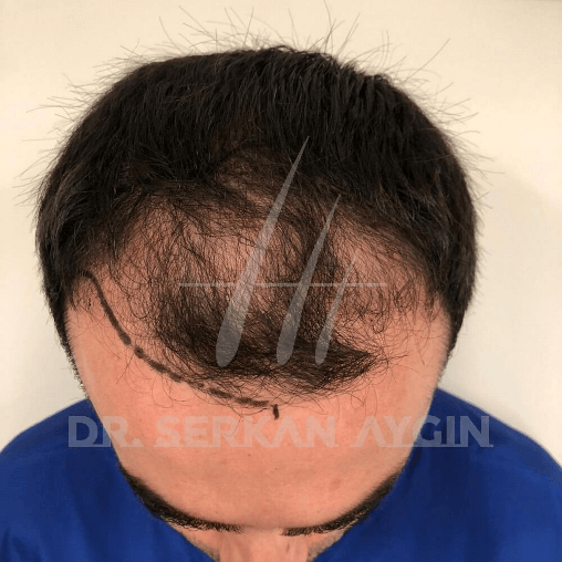 Resultado del trasplante de pelo antes y después - 5