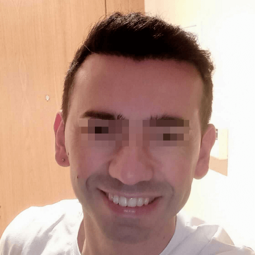 El resultado de un trasplante de cabello en un hombre antes y después - 6