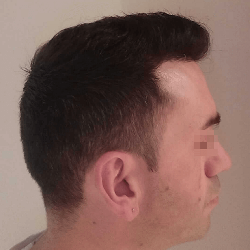 El resultado de un trasplante de cabello en un hombre antes y después - 8