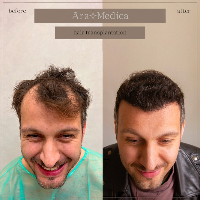 Trasplante de cabello antes y después 2023 1