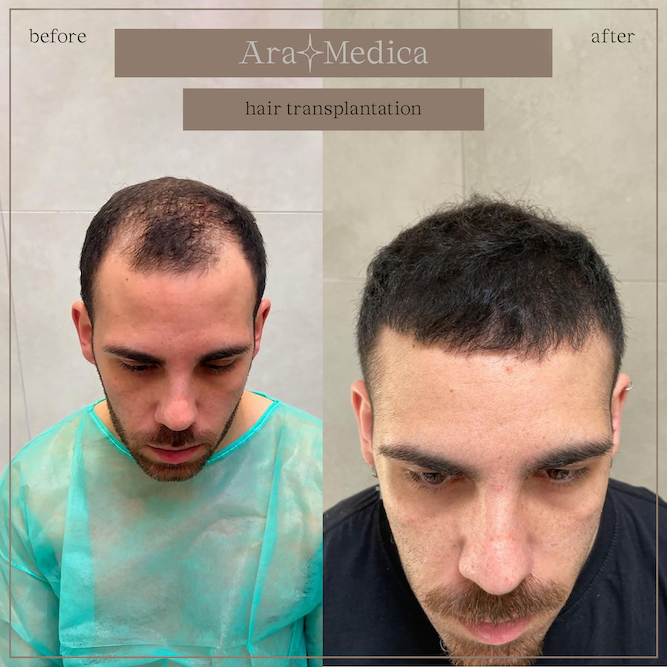 Trasplante de cabello antes y después 2023 1