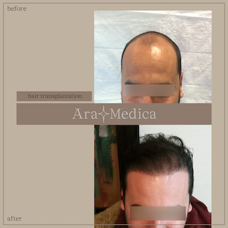 Trasplante de cabello antes y después 2023 10