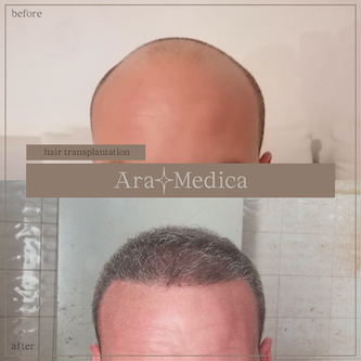 Trasplante de cabello antes y después 2023 17