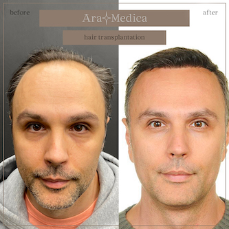 Trasplante de cabello antes y después 2023 19
