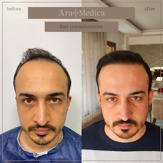 Trasplante de cabello antes y después 2023 21