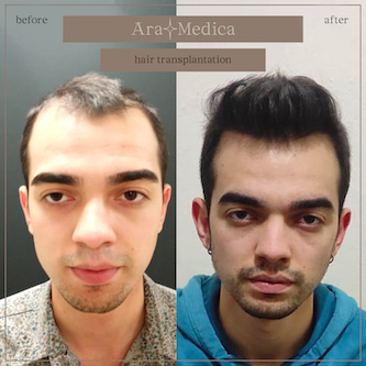 Trasplante de cabello antes y después 2023 23