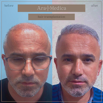Trasplante de cabello antes y después 2023 24