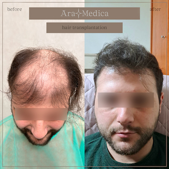 Trasplante de cabello antes y después 2023 3