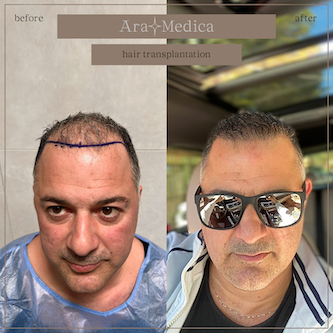 Trasplante de cabello antes y después 2023 4