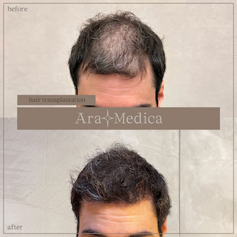 Trasplante de cabello antes y después 2023 6