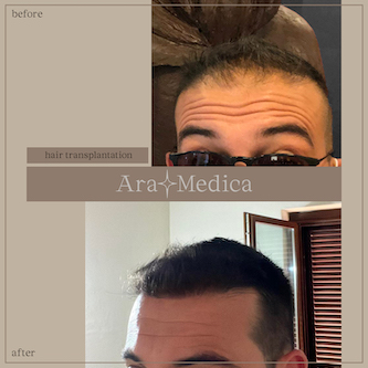 Trasplante de cabello antes y después 2023 7