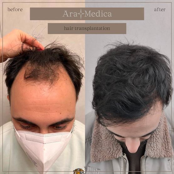 Trasplante de cabello antes y después 2023 1