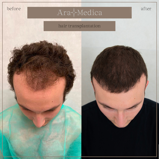 Trasplante de cabello antes y después 2023 2