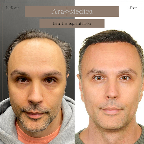 Trasplante de cabello antes y después 2023 5