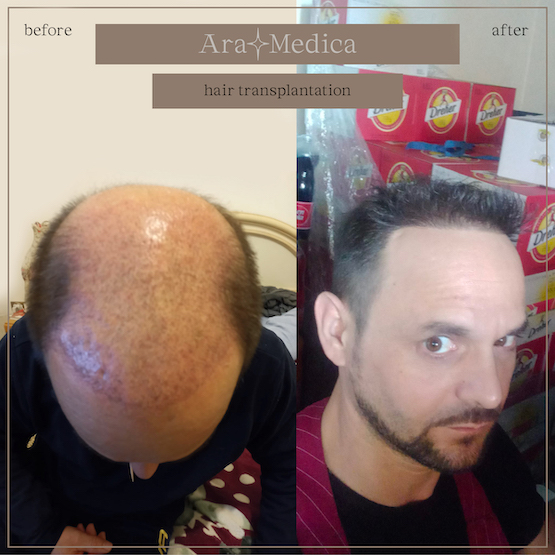 Trasplante de cabello antes y después 2023 6