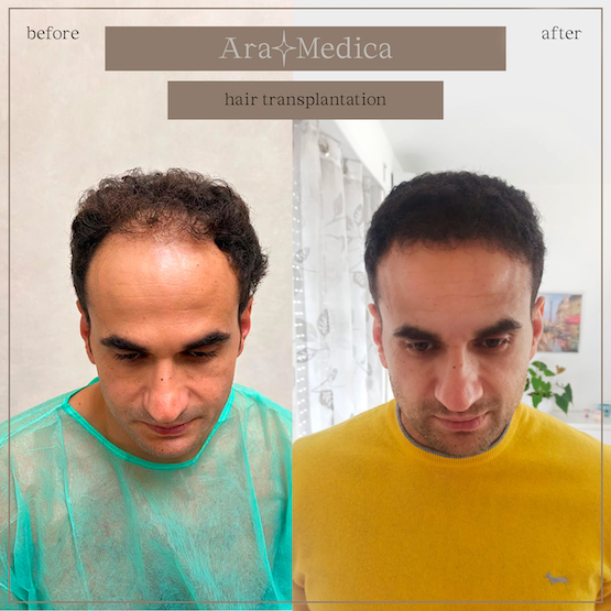 Trasplante de cabello antes y después 2023 8