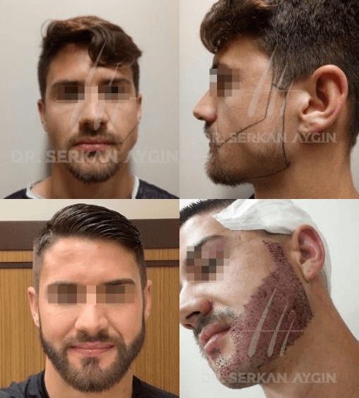 Foto de trasplante de pelo de barba - resultado antes y después