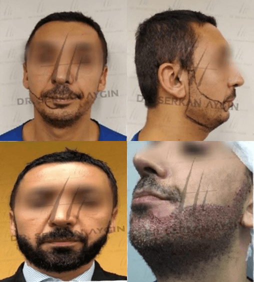 Foto de trasplante capilar de barba - resultado antes y después