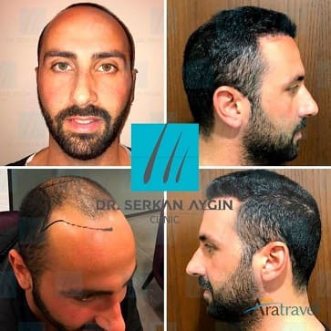 Trasplante de cabello ejemplo uno