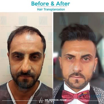 Trasplante de cabello ejemplo dos