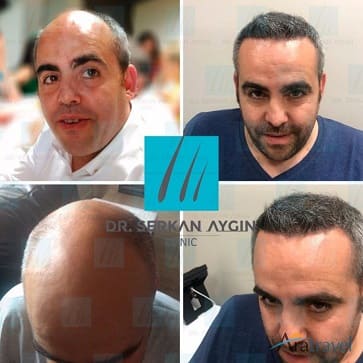 Trasplante de cabello ejemplo tres