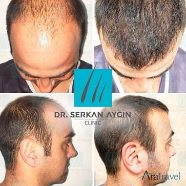 Trasplante de cabello ejemplo cuatro