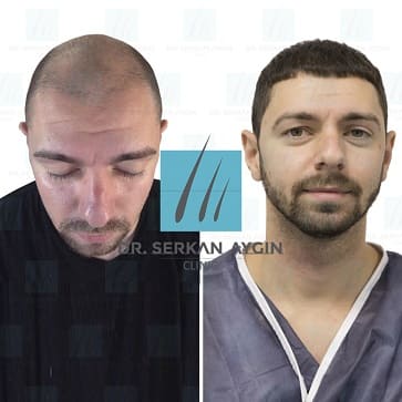 Trasplante de cabello ejemplo seis