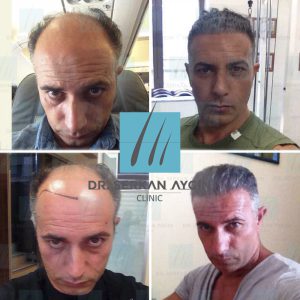 Trasplante de cabello antes y después - 3